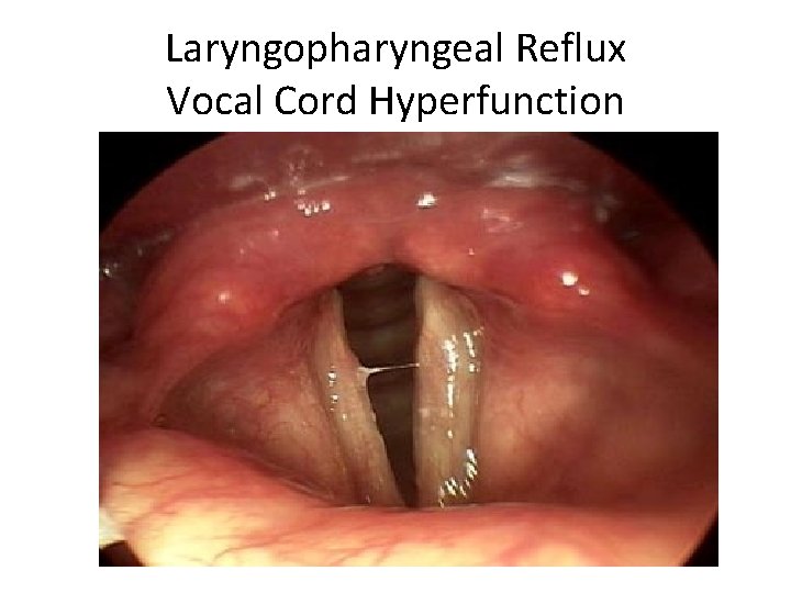 Laryngopharyngeal Reflux Vocal Cord Hyperfunction 