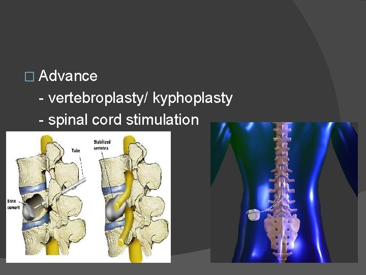 � Advance - vertebroplasty/ kyphoplasty - spinal cord stimulation 