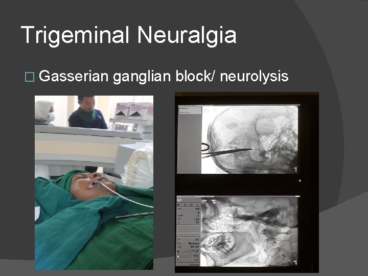 Trigeminal Neuralgia � Gasserian ganglian block/ neurolysis 