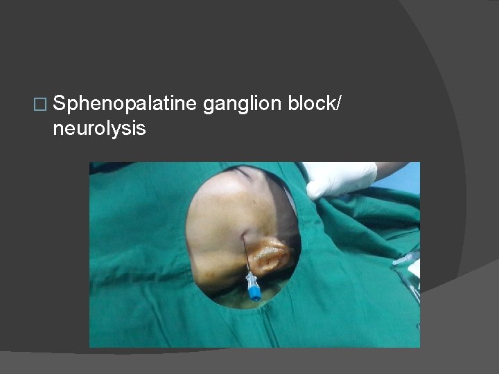 � Sphenopalatine neurolysis ganglion block/ 