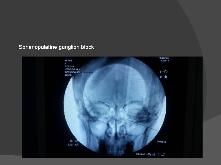 Sphenopalatine ganglion block 