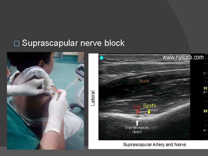 � Suprascapular nerve block 