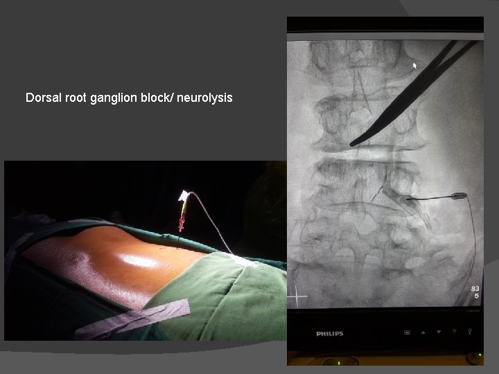 Dorsal root ganglion block/ neurolysis 