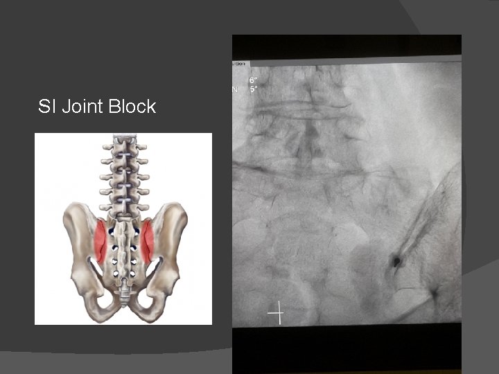 SI Joint Block 