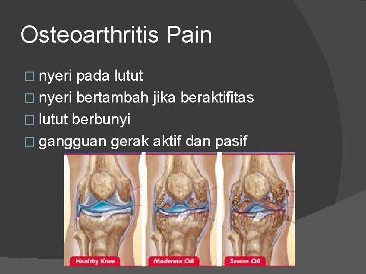 Osteoarthritis Pain � nyeri pada lutut � nyeri bertambah jika beraktifitas � lutut berbunyi