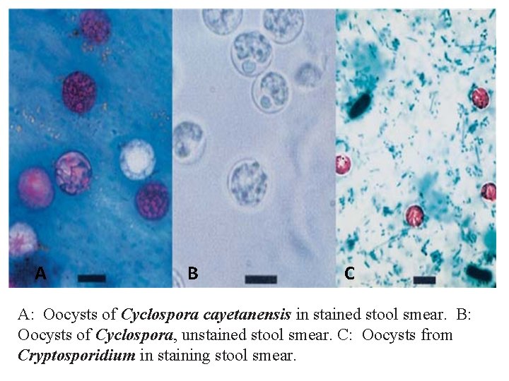 A B C A: Oocysts of Cyclospora cayetanensis in stained stool smear. B: Oocysts