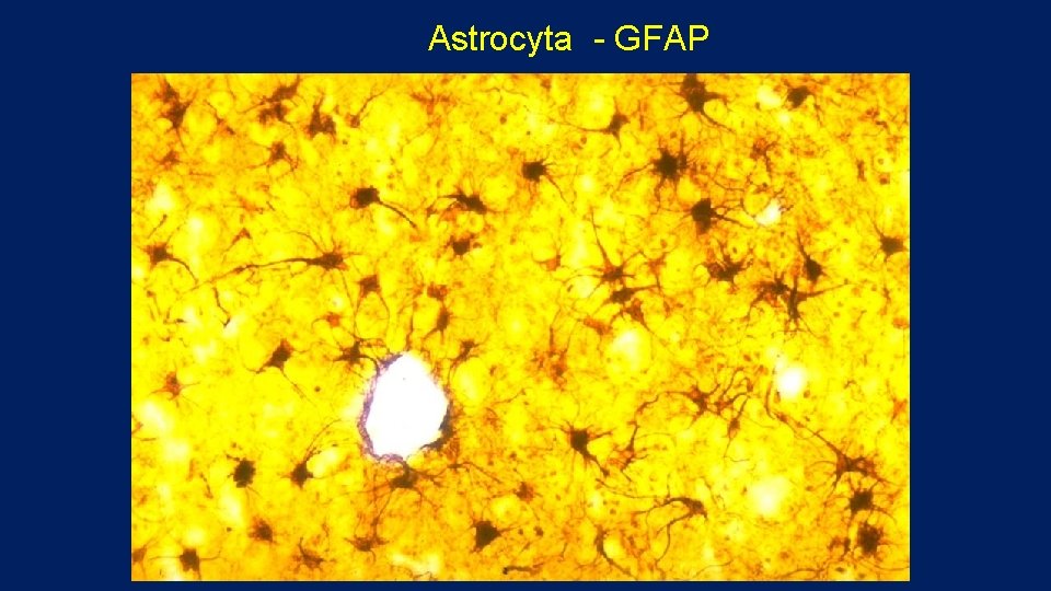 Astrocyta - GFAP 