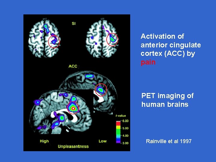 Activation of anterior cingulate cortex (ACC) by pain PET imaging of human brains Rainville