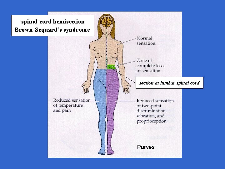 spinal-cord hemisection Brown-Sequard’s syndrome section at lumbar spinal cord Purves 
