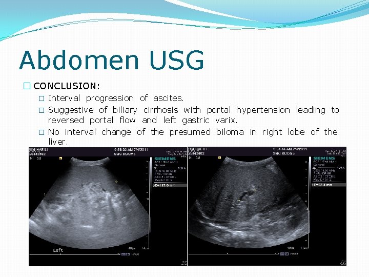 Abdomen USG � CONCLUSION: � Interval progression of ascites. � Suggestive of biliary cirrhosis