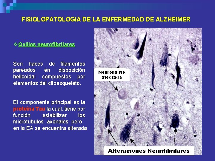 FISIOLOPATOLOGIA DE LA ENFERMEDAD DE ALZHEIMER v. Ovillos neurofibrilares Son haces de filamentos pareados