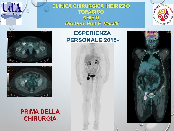 CLINICA CHIRURGICA INDIRIZZO TORACICO CHIETI Direttore Prof F. Mucilli ESPERIENZA PERSONALE 20152019 PRIMA DELLA