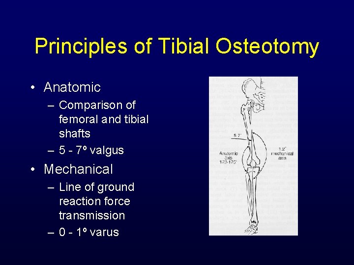 Principles of Tibial Osteotomy • Anatomic – Comparison of femoral and tibial shafts –