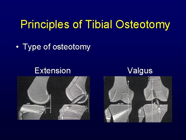 Principles of Tibial Osteotomy • Type of osteotomy Extension Valgus 