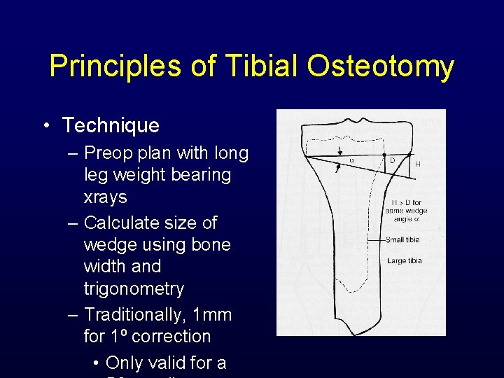 Principles of Tibial Osteotomy • Technique – Preop plan with long leg weight bearing