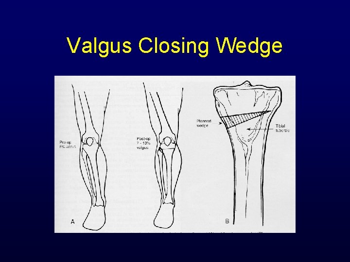 Valgus Closing Wedge 