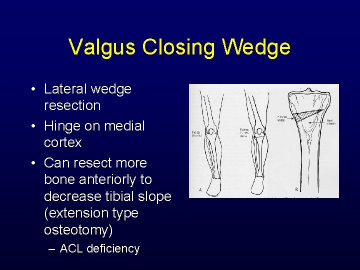 Valgus Closing Wedge • Lateral wedge resection • Hinge on medial cortex • Can