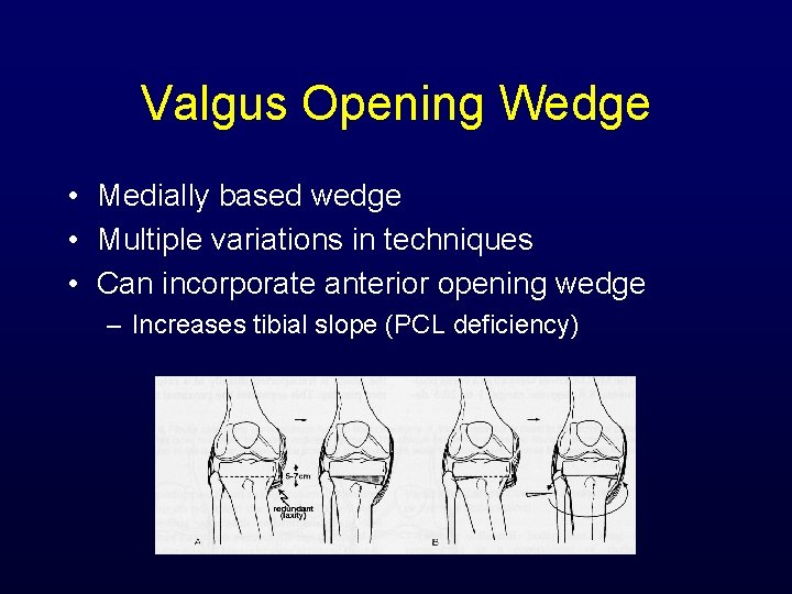 Valgus Opening Wedge • Medially based wedge • Multiple variations in techniques • Can