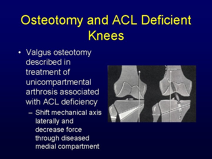 Osteotomy and ACL Deficient Knees • Valgus osteotomy described in treatment of unicompartmental arthrosis