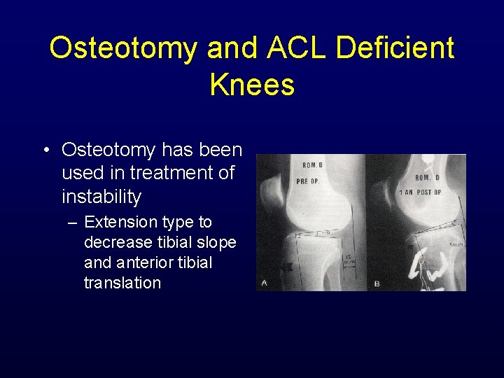 Osteotomy and ACL Deficient Knees • Osteotomy has been used in treatment of instability