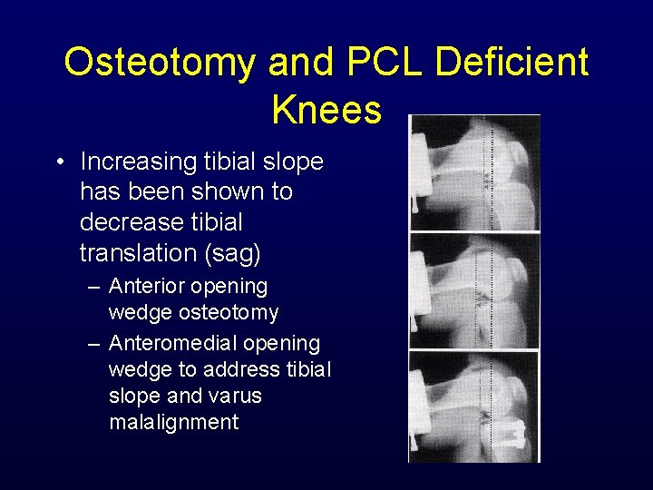 Osteotomy and PCL Deficient Knees • Increasing tibial slope has been shown to decrease