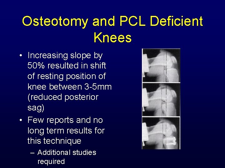 Osteotomy and PCL Deficient Knees • Increasing slope by 50% resulted in shift of