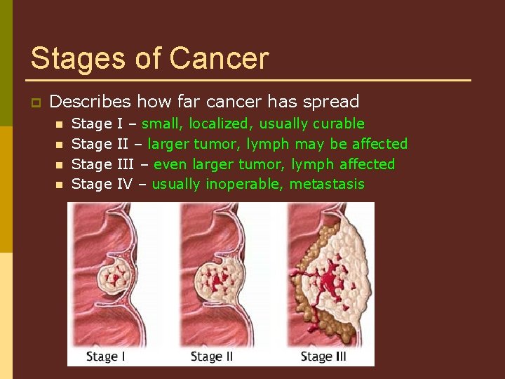 Stages of Cancer p Describes how far cancer has spread n n Stage I