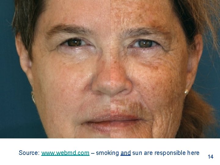 Source: www. webmd. com – smoking and sun are responsible here 14 