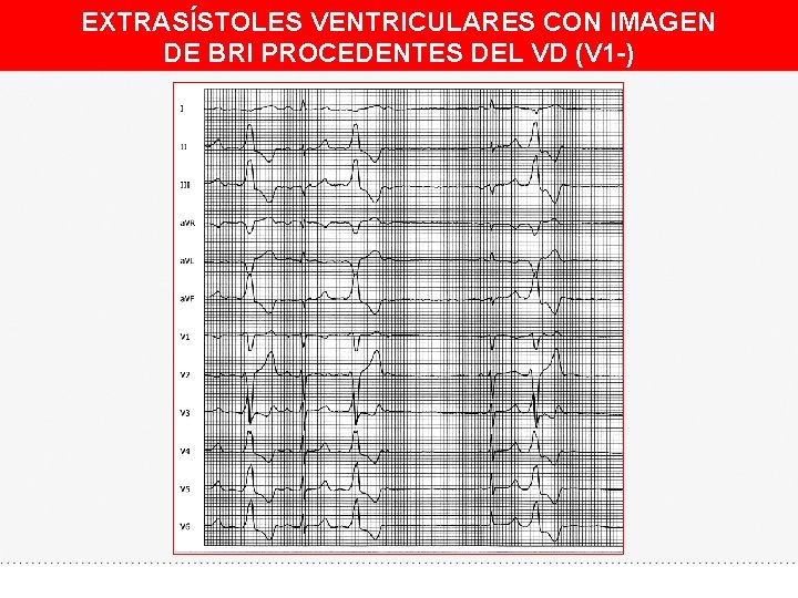 EXTRASÍSTOLES VENTRICULARES CON IMAGEN DE BRI PROCEDENTES DEL VD (V 1 -) 