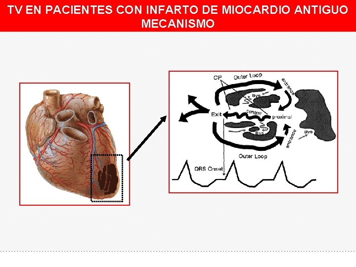 TV EN PACIENTES CON INFARTO DE MIOCARDIO ANTIGUO MECANISMO 