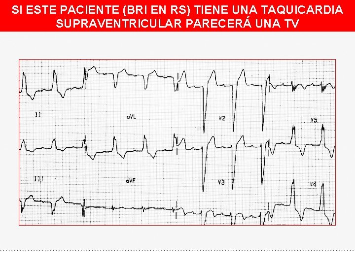 SI ESTE PACIENTE (BRI EN RS) TIENE UNA TAQUICARDIA SUPRAVENTRICULAR PARECERÁ UNA TV 