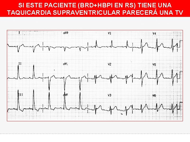 SI ESTE PACIENTE (BRD+HBPI EN RS) TIENE UNA TAQUICARDIA SUPRAVENTRICULAR PARECERÁ UNA TV 