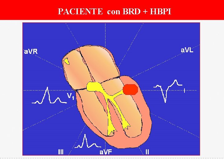 PACIENTE con BRD + HBPI 