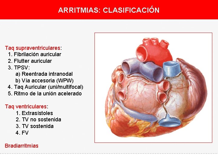 ARRITMIAS: CLASIFICACIÓN Taq supraventriculares: 1. Fibrilación auricular 2. Flutter auricular 3. TPSV: a) Reentrada