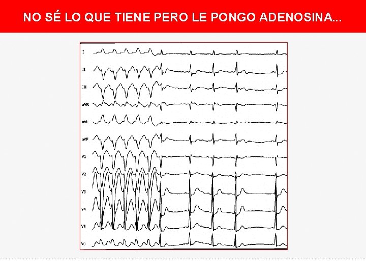 NO SÉ LO QUE TIENE PERO LE PONGO ADENOSINA. . . 