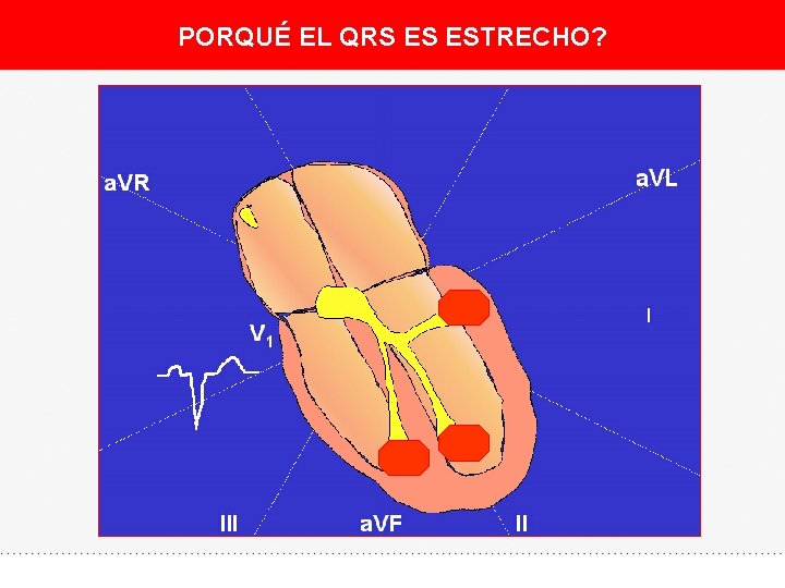 PORQUÉ EL QRS ES ESTRECHO? 