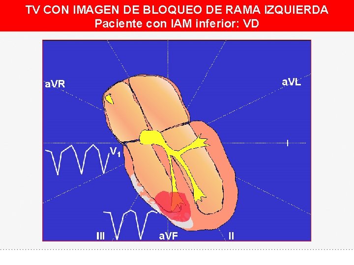 TV CON IMAGEN DE BLOQUEO DE RAMA IZQUIERDA Paciente con IAM inferior: VD 