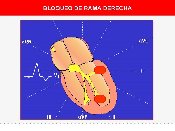 BLOQUEO DE RAMA DERECHA 