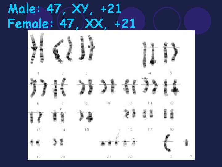 Male: 47, XY, +21 Female: 47, XX, +21 