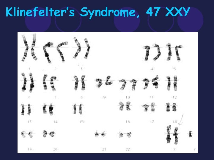 Klinefelter’s Syndrome, 47 XXY 