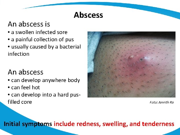 An abscess is Abscess • a swollen infected sore • a painful collection of