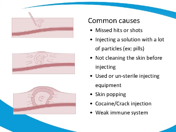 Common causes • Missed hits or shots • Injecting a solution with a lot