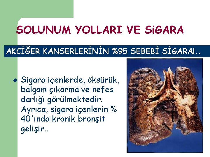 SOLUNUM YOLLARI VE Si. GARA AKCİĞER KANSERLERİNİN %95 SEBEBİ SİGARA!. . l Sigara içenlerde,