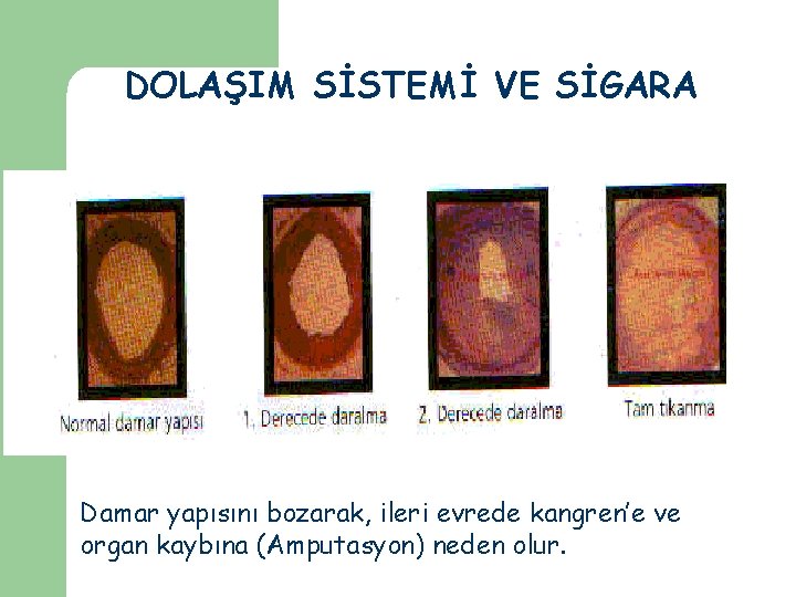 DOLAŞIM SİSTEMİ VE SİGARA Damar yapısını bozarak, ileri evrede kangren’e ve organ kaybına (Amputasyon)