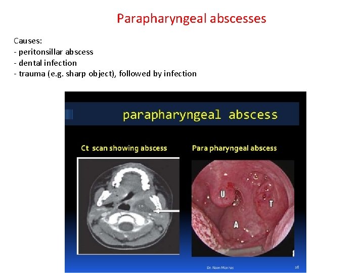 Parapharyngeal abscesses Causes: - peritonsillar abscess - dental infection - trauma (e. g. sharp Parapharyngeal abscesses Causes: - peritonsillar abscess - dental infection - trauma (e. g. sharp