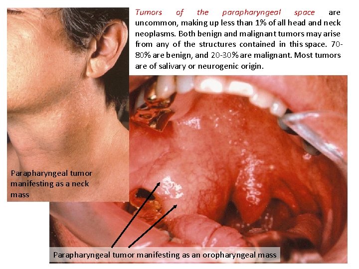 Tumors of the parapharyngeal space are uncommon, making up less than 1% of all Tumors of the parapharyngeal space are uncommon, making up less than 1% of all