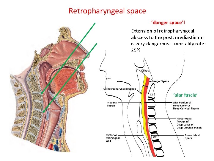 Retropharyngeal space ‘danger space’! Extension of retropharyngeal abscess to the post. mediastinum is very Retropharyngeal space ‘danger space’! Extension of retropharyngeal abscess to the post. mediastinum is very