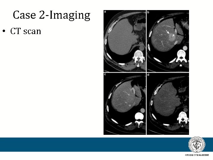 Case 2 -Imaging • CT scan 