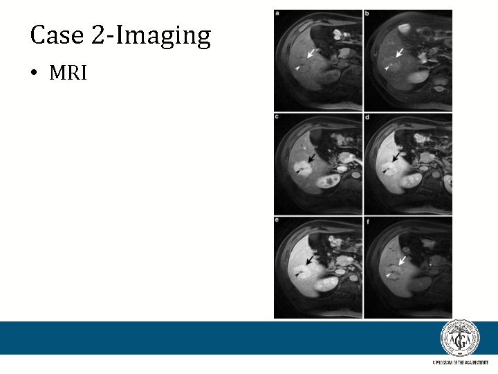 Case 2 -Imaging • MRI 
