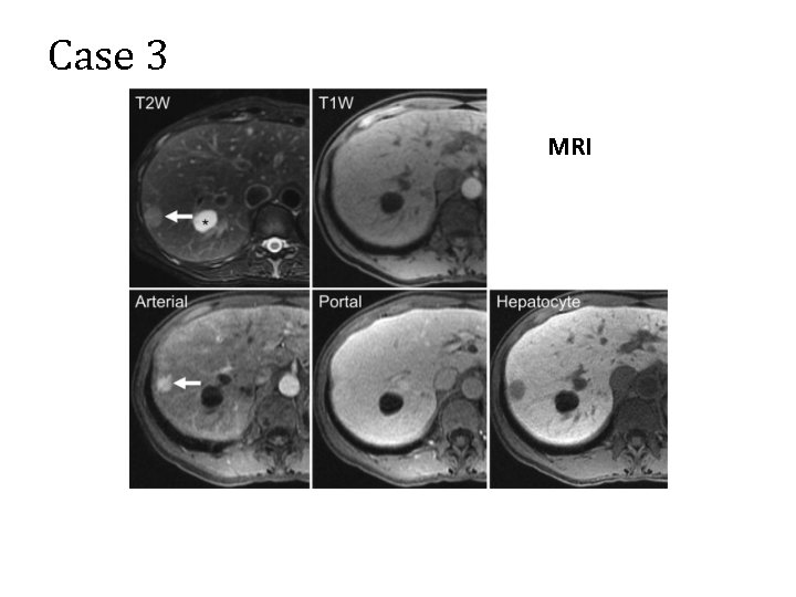 Case 3 MRI 
